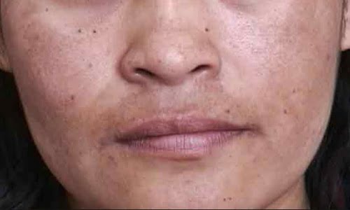 Mélasma ou chloasma. Traitement naturel pour l'éliminer définitivement 2 éliminer définitivement le mélasma