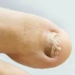Remèdes à la maison pour la mycose des ongles